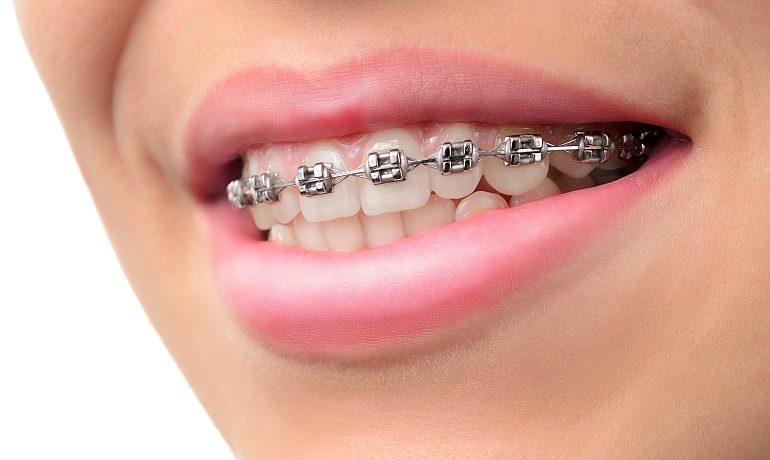 Ravni zubi - ne radi se samo o lijepom osmijehu. 4 medicinske prednosti aparatića