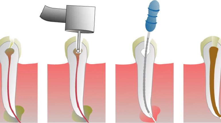 Šta je endodoncija?