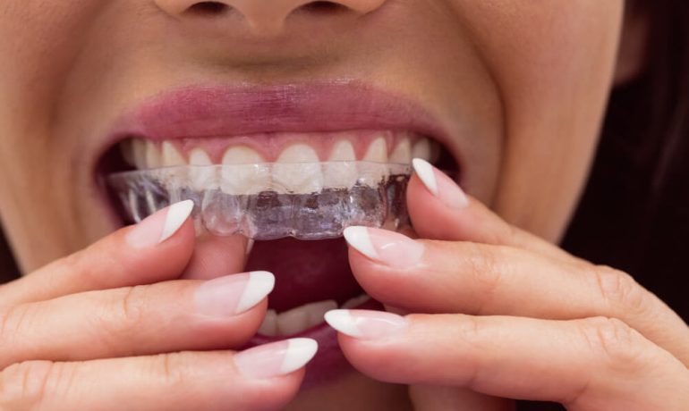Folije za ispravljanje zuba: Da li je to pravo rješenje za vas?